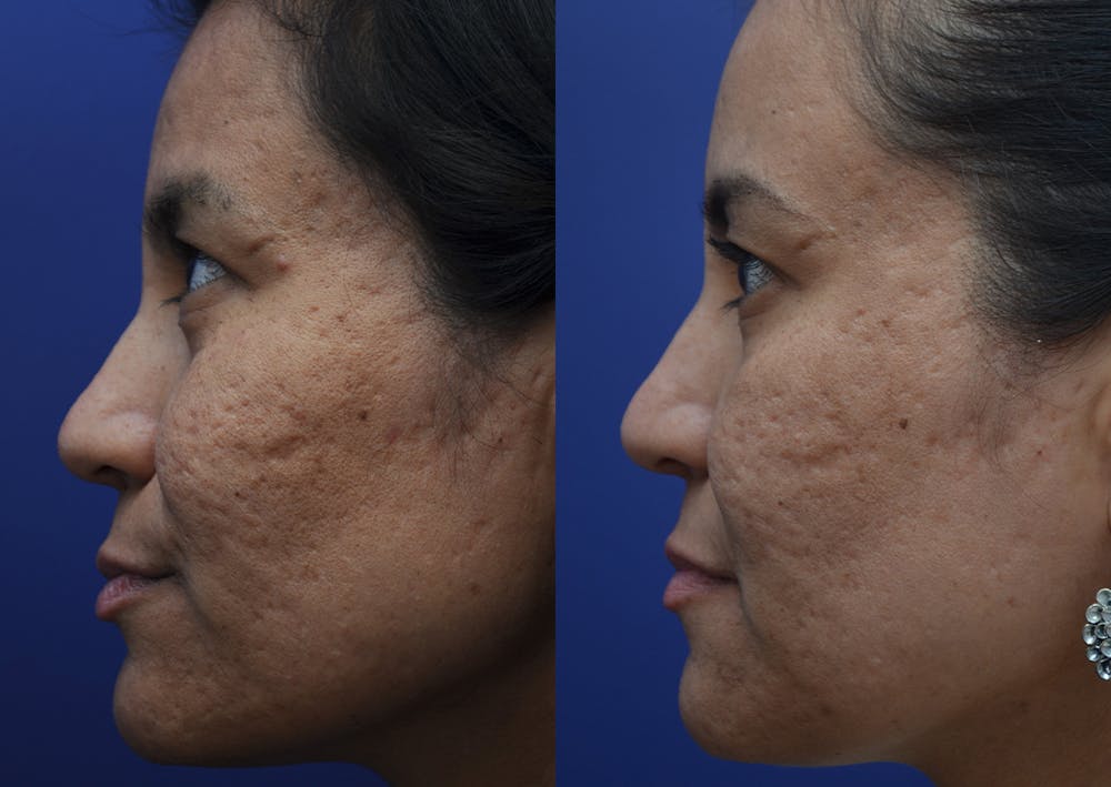 Micro Needling Before & After Gallery - Patient 5788737 - Image 1