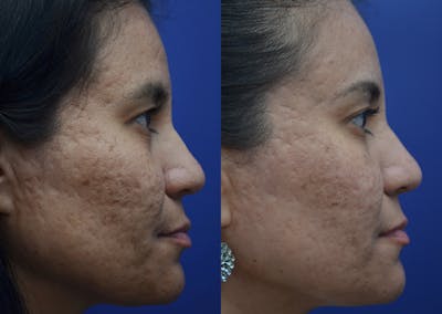 Micro Needling Before & After Gallery - Patient 5788737 - Image 2