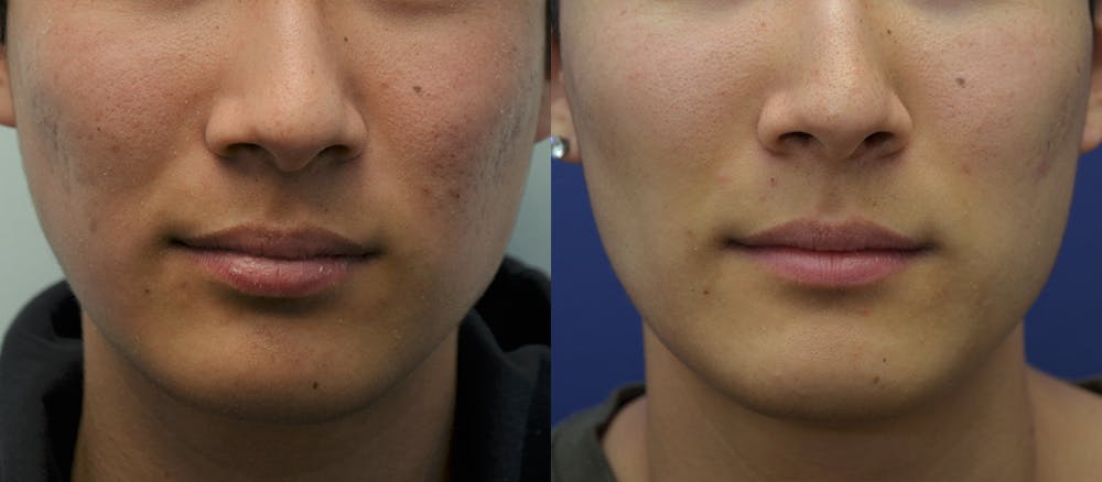 Micro Needling Before & After Gallery - Patient 5788738 - Image 1