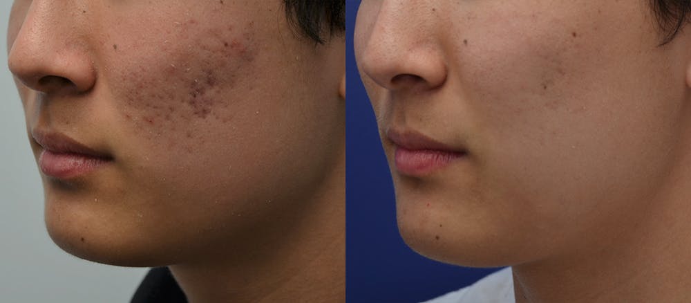 Micro Needling Before & After Gallery - Patient 5788738 - Image 2