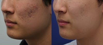 Micro Needling Before & After Gallery - Patient 5788738 - Image 2