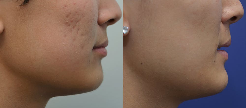 Micro Needling Before & After Gallery - Patient 5788738 - Image 5