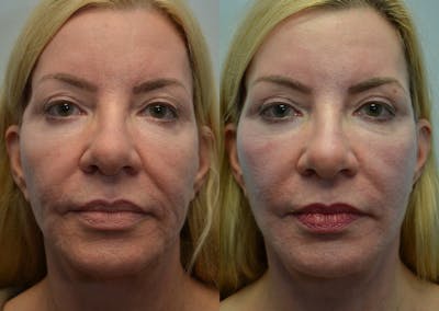 Deep Plane Facelift Before & After Gallery - Patient 4588121 - Image 2
