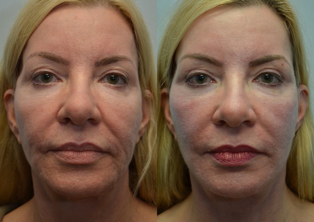 Facelift Before & After Gallery - Patient 4588121 - Image 2