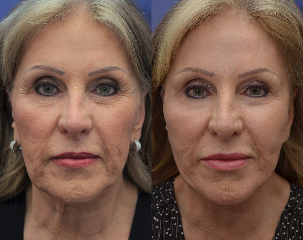 Facelift Before & After Gallery - Patient 5882979 - Image 1