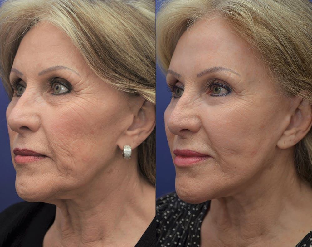 Facelift Before & After Gallery - Patient 5882979 - Image 3