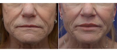 Non-Surgical Soft Tissue Fillers Before & After Gallery - Patient 5883017 - Image 1