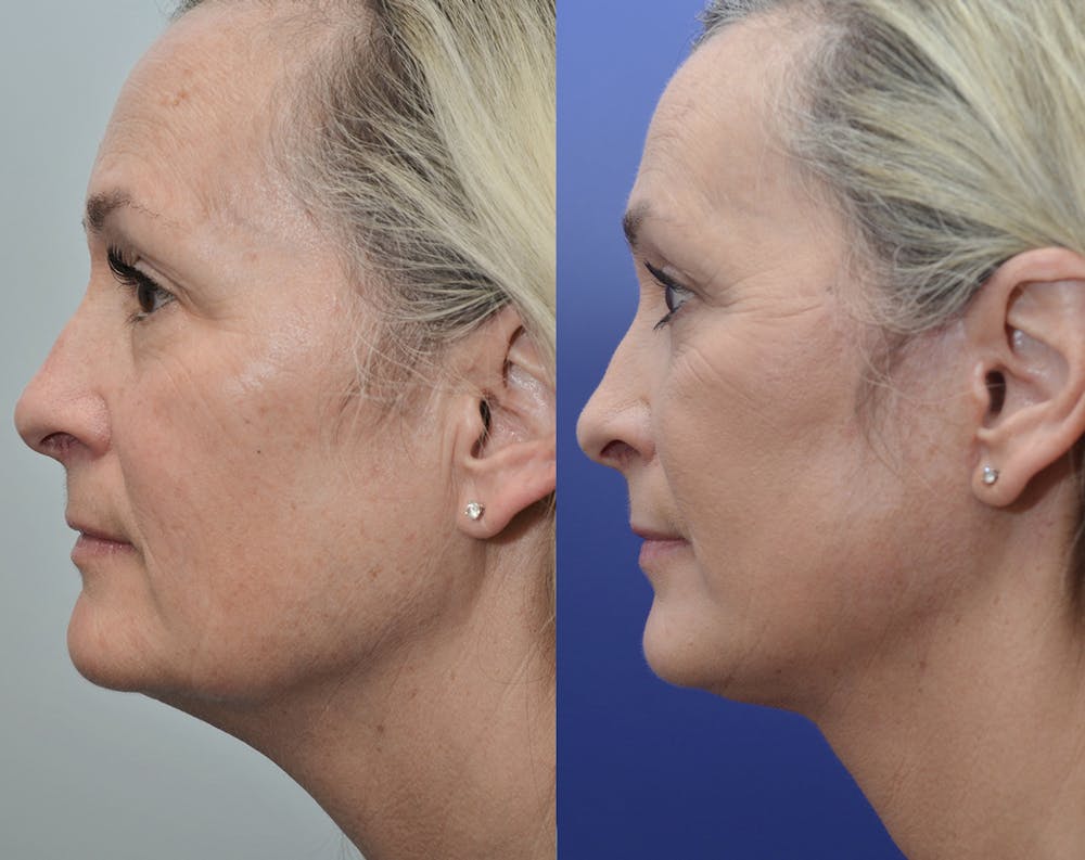 Facelift Before & After Gallery - Patient 5929080 - Image 1