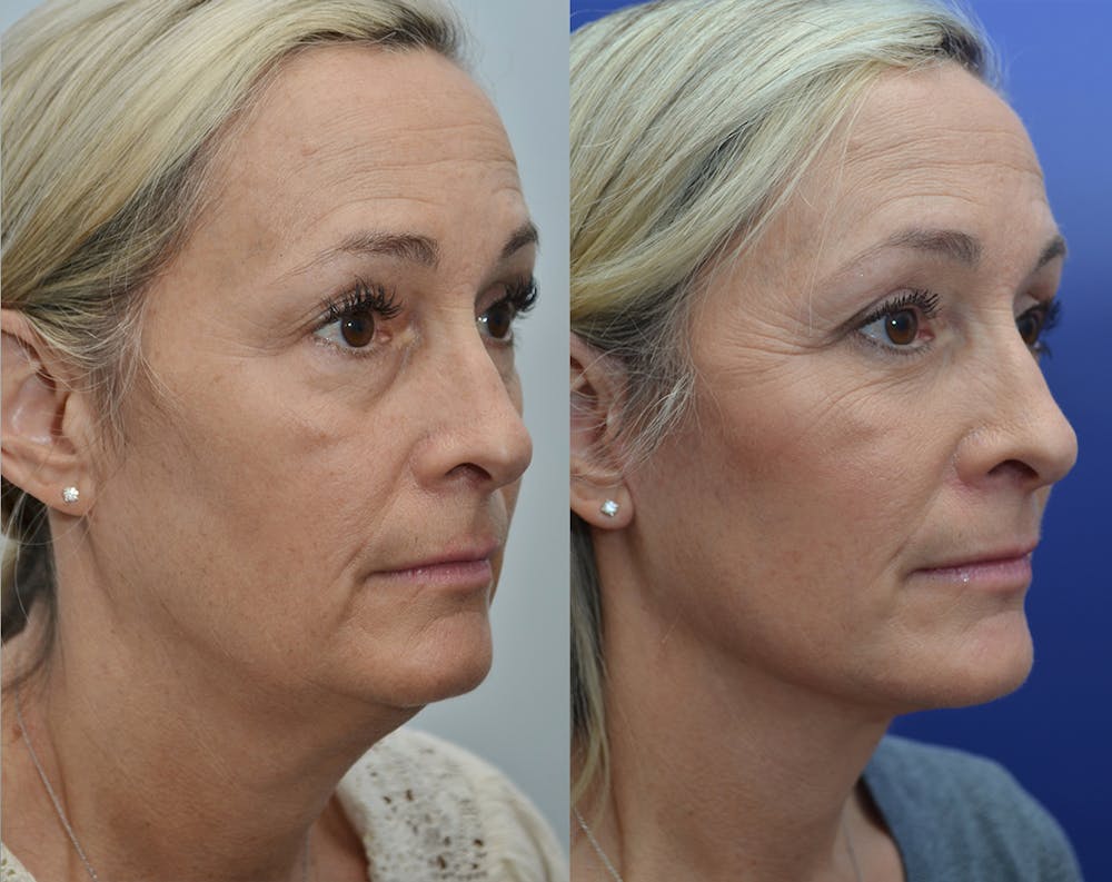 Deep Plane Facelift Before & After Gallery - Patient 5929080 - Image 3