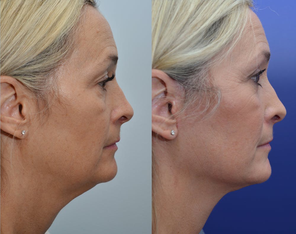 Deep Plane Facelift Before & After Gallery - Patient 5929080 - Image 2