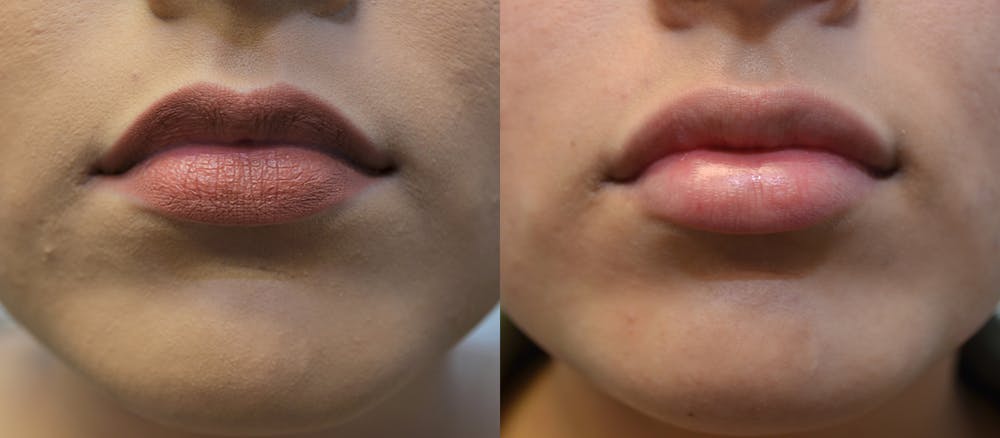 Lip Enhancement Before & After Gallery - Patient 4588511 - Image 1