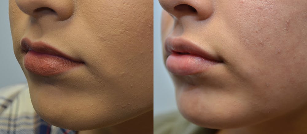 Lip Enhancement Before & After Gallery - Patient 4588511 - Image 2