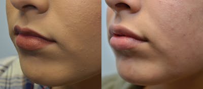 Lip Enhancement Before & After Gallery - Patient 4588511 - Image 2