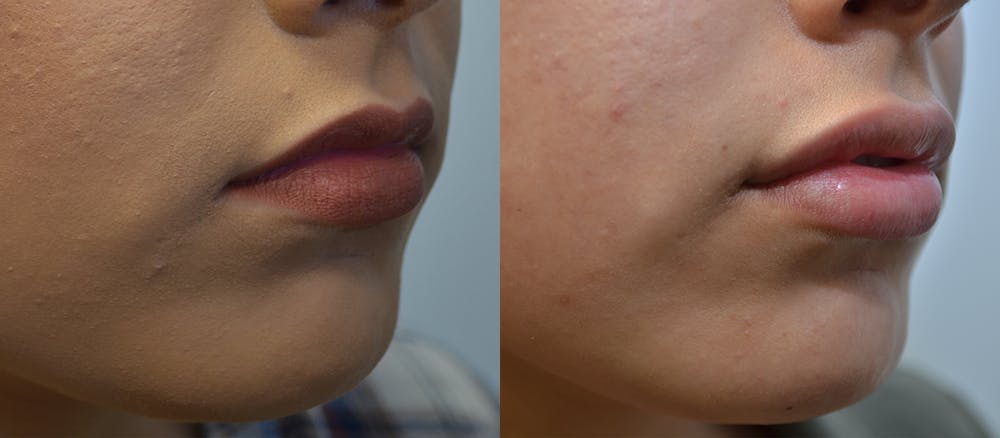 Lip Enhancement Before & After Gallery - Patient 4588511 - Image 4