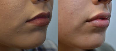 Non-Surgical Soft Tissue Fillers Before & After Gallery - Patient 5929321 - Image 4