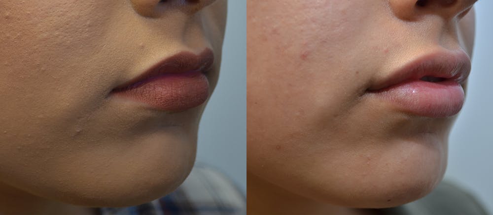 Non-Surgical Soft Tissue Fillers Before & After Gallery - Patient 5929321 - Image 4