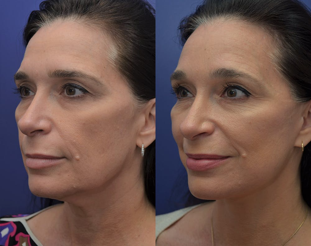 Deep Plane Facelift Before & After Gallery - Patient 5930601 - Image 1