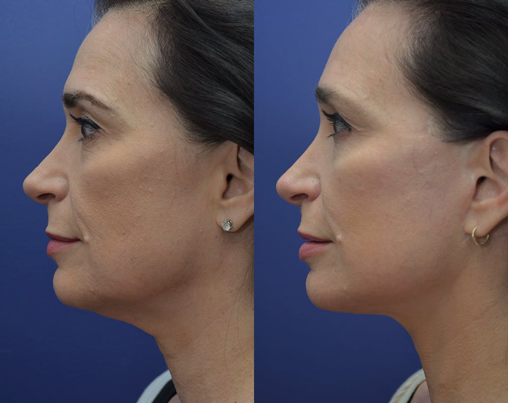 Deep Plane Facelift Before & After Gallery - Patient 5930601 - Image 4