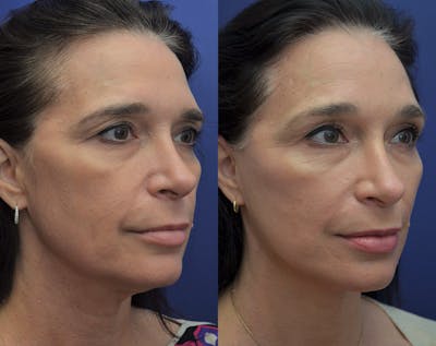 Deep Plane Facelift Before & After Gallery - Patient 5930601 - Image 2