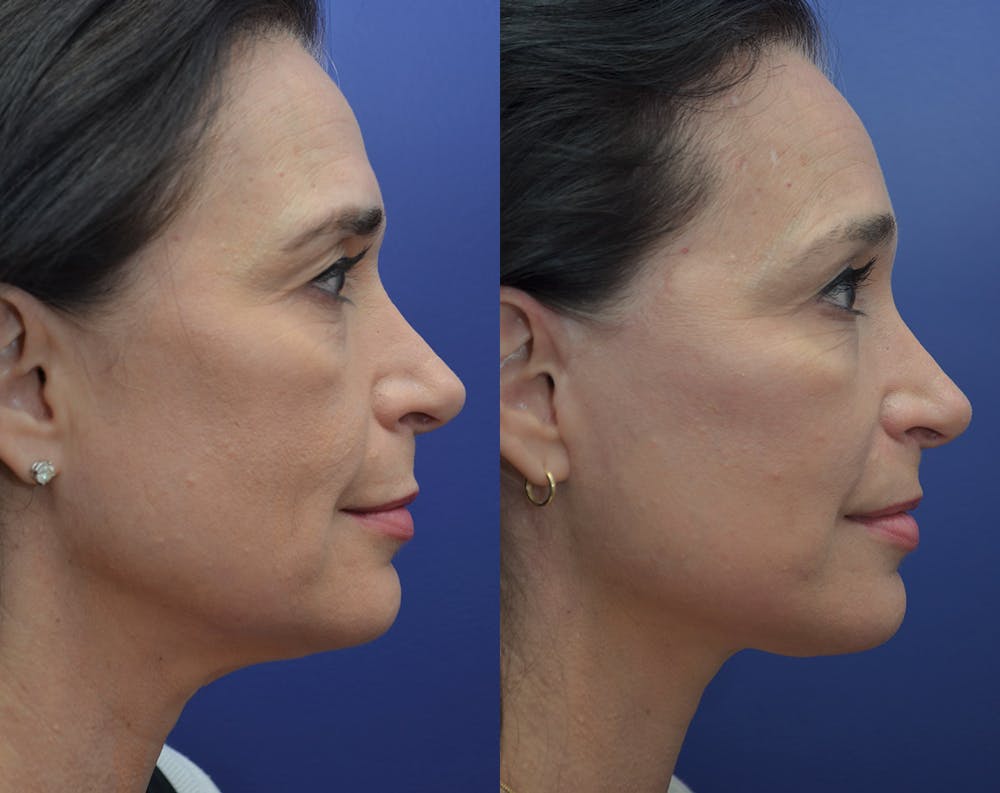 Deep Plane Facelift Before & After Gallery - Patient 5930601 - Image 3