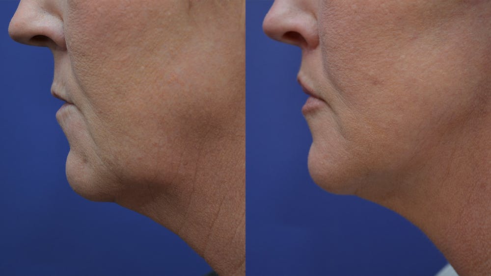Lip Lift Before & After Gallery - Patient 4588525 - Image 3