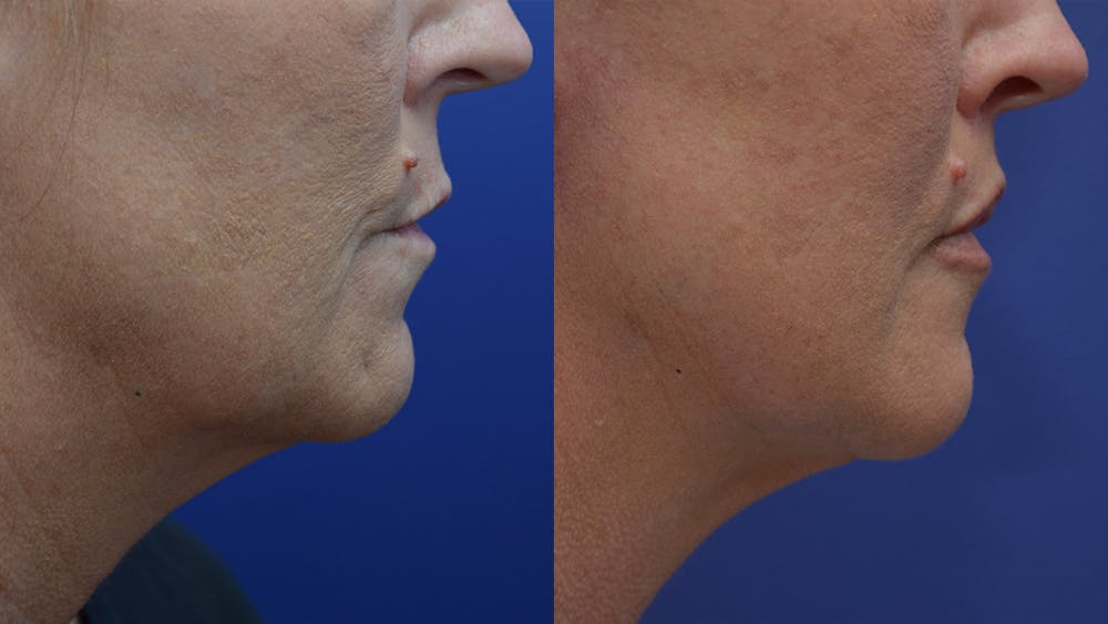Lip Lift Before & After Gallery - Patient 4588525 - Image 2