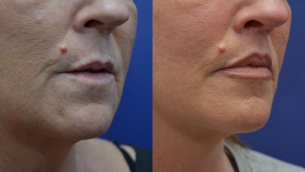 Lip Lift Before & After Gallery - Patient 4588525 - Image 1
