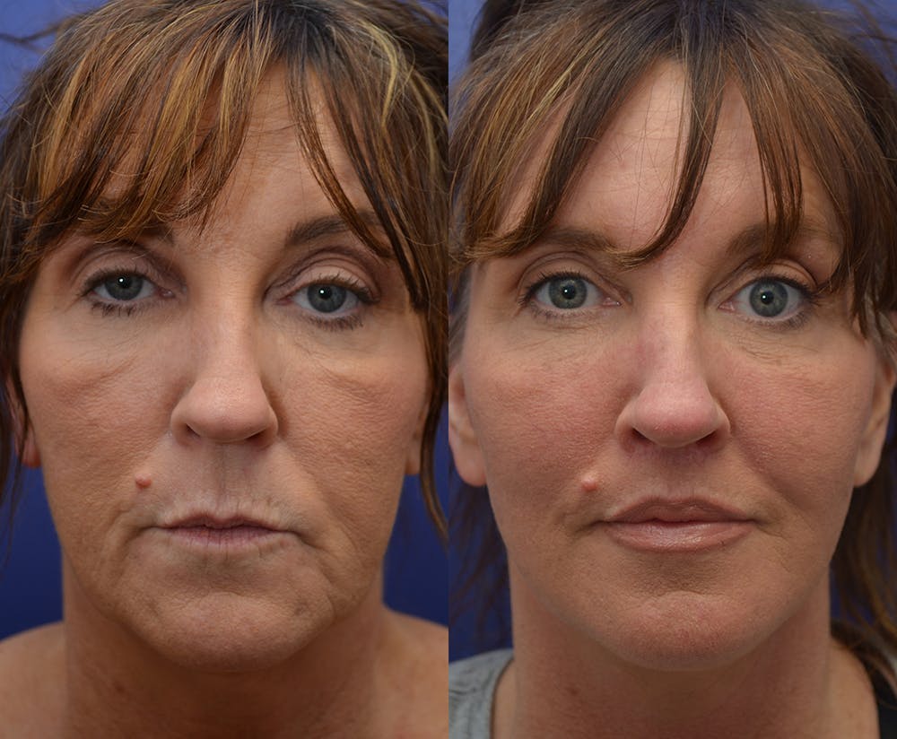 Deep Plane Facelift Before & After Gallery - Patient 4641389 - Image 1