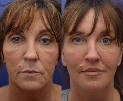 Deep Plane Facelift Before & After Gallery - Patient 4641389 - Image 1