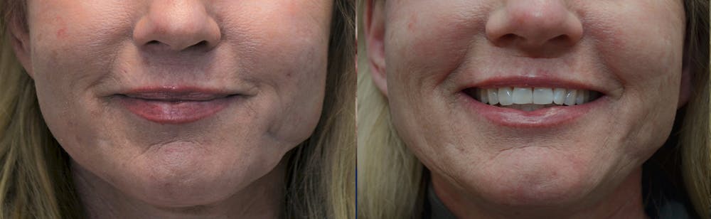 Scar Revision Before & After Gallery - Patient 4588501 - Image 2