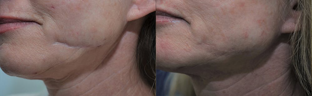 Scar Revision Before & After Gallery - Patient 4588501 - Image 3