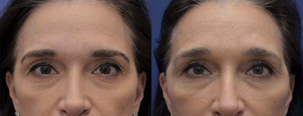 Brow Lift (Forehead Lift) Gallery - Patient 5930602 - Image 1