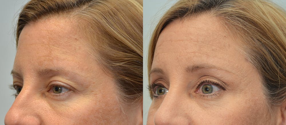 Brow Lift (Forehead Lift) Before & After Gallery - Patient 4588641 - Image 2