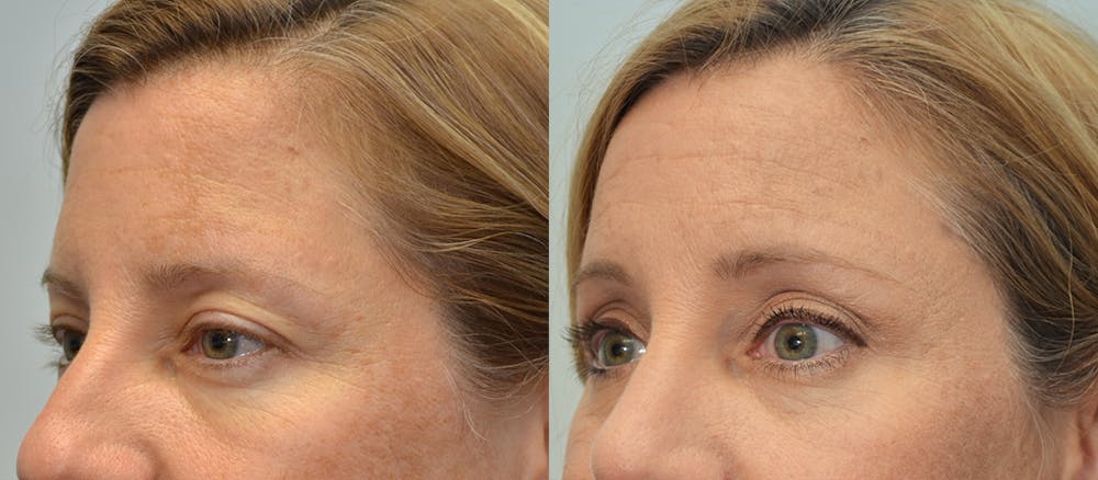 Brow Lift (Forehead Lift) Gallery - Patient 4588641 - Image 2