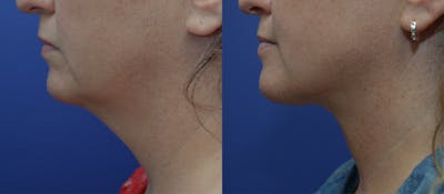 Deep Plane Neck Lift Before & After Gallery - Patient 5288973 - Image 1