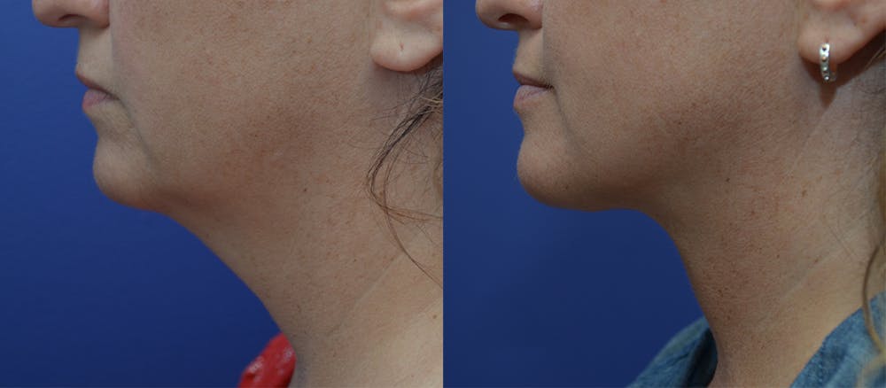 Deep Plane Neck Lift Before & After Gallery - Patient 5288973 - Image 1