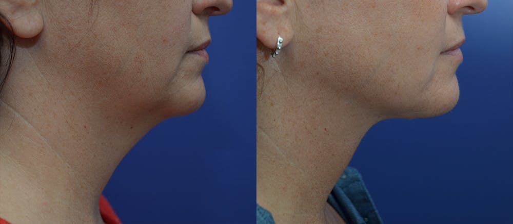 Deep Plane Neck Lift Before & After Gallery - Patient 5288973 - Image 2