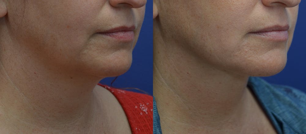 Neck Lift Before & After Gallery - Patient 5288973 - Image 3