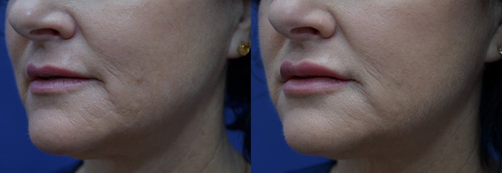 Lip Enhancement Before & After Gallery - Patient 8694344 - Image 2