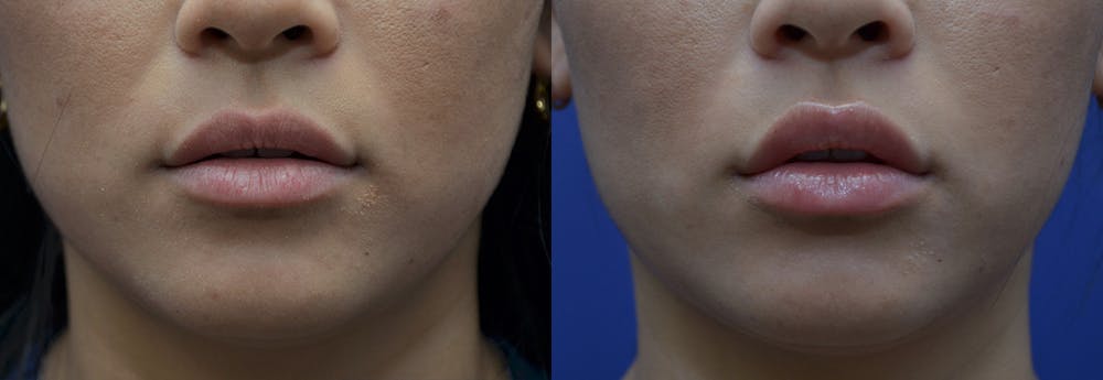 Lip Enhancement Before & After Gallery - Patient 8694345 - Image 1