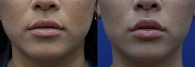 Lip Enhancement Before & After Gallery - Patient 8694345 - Image 1