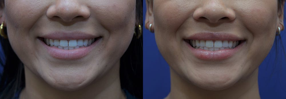Lip Enhancement Before & After Gallery - Patient 8694345 - Image 2