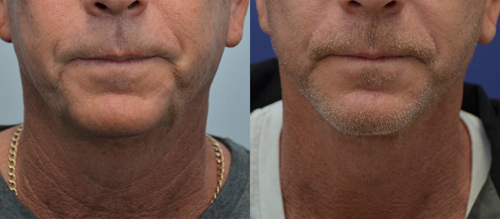 Deep Plane Facelift Before & After Gallery - Patient 4588150 - Image 3