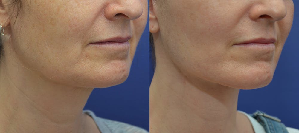 Deep Plane Facelift Before & After Gallery - Patient 5882980 - Image 2