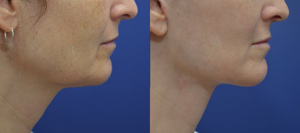 Deep Plane Facelift Before & After Gallery - Patient 5882980 - Image 5