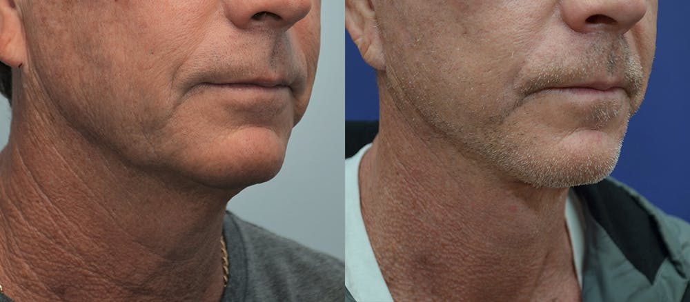 Deep Plane Facelift Before & After Gallery - Patient 4588150 - Image 1