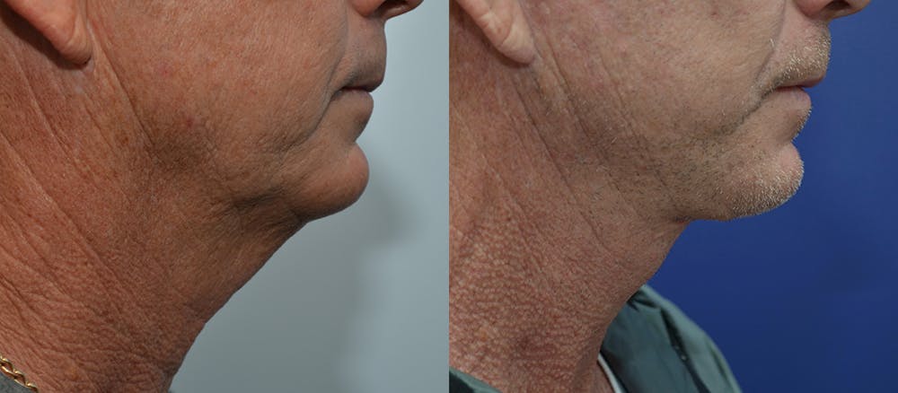 Deep Plane Facelift Before & After Gallery - Patient 4588150 - Image 2