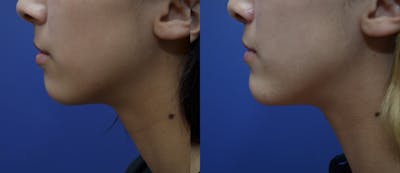 Chin Augmentation Before & After Gallery - Patient 14391566 - Image 2