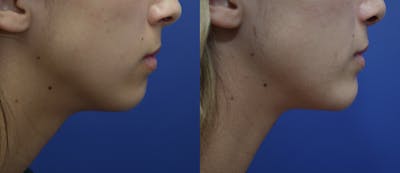 Chin Augmentation Before & After Gallery - Patient 14391566 - Image 4