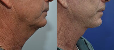 Deep Plane Neck Lift Before & After Gallery - Patient 4588346 - Image 2